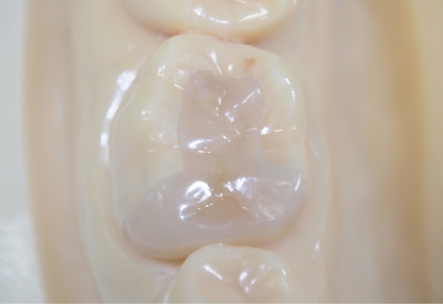 セラミックインレー